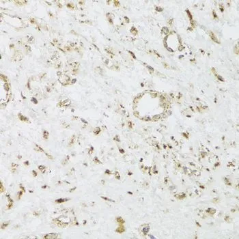 IHC-P analysis of human leiomyoma of uterus tissue using GTX55572 CIAPIN1 antibody. Dilution : 1:100
