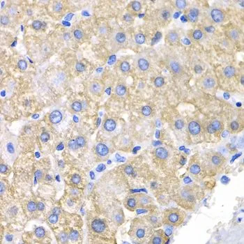 IHC-P analysis of human liver cancer tissue using GTX55580 CRK antibody. Dilution : 1:200