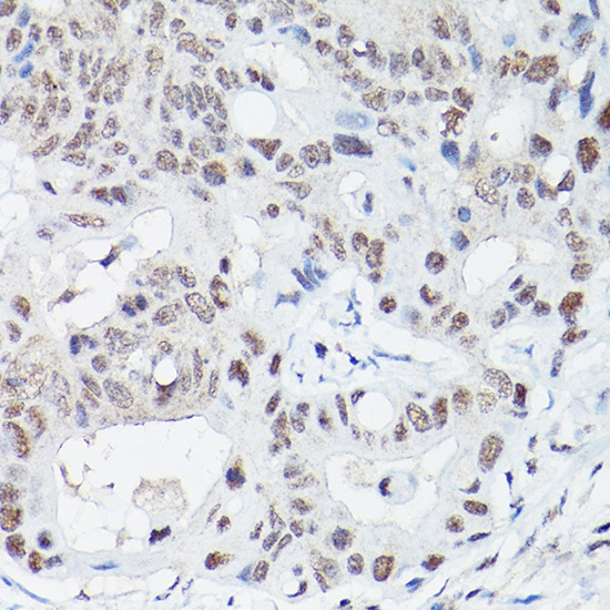 IHC-P analysis of human colon carcinoma tissue using GTX55592 DNA ligase IV antibody. Antigen retrieval : High pressure antigen retrieval with 10 mM citrate buffer pH 6.0 Dilution : 1:100 IHC-P analysis of human colon carcinoma tissue using GTX55592 DNA ligase IV antibody. Antigen retrieval : High pressure antigen retrieval with 10 mM citrate buffer pH 6.0 Dilution : 1:100