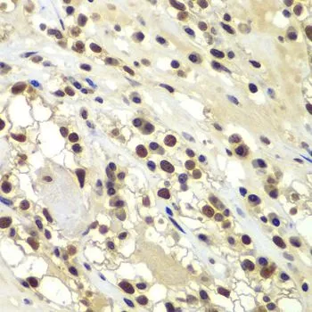 IHC-P analysis of human kidney cancer tissue using GTX55593 DNA-PKcs antibody. Dilution : 1:100