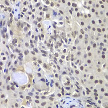 IHC-P analysis of human well-differentiated squamous skin carcinoma tissue using GTX55593 DNA-PKcs antibody. Dilution : 1:100