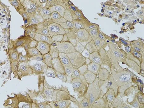 IHC-P analysis of human breast cancer tissue using GTX55638 GGT1 antibody. Dilution : 1:100