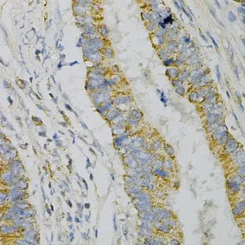 IHC-P analysis of human colon carcinoma tissue using GTX55644 GNAO1 antibody. Dilution : 1:100