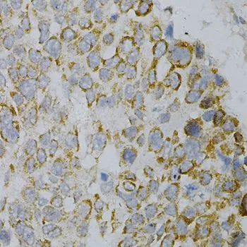 IHC-P analysis of human esophageal cancer tissue using GTX55644 GNAO1 antibody. Dilution : 1:100