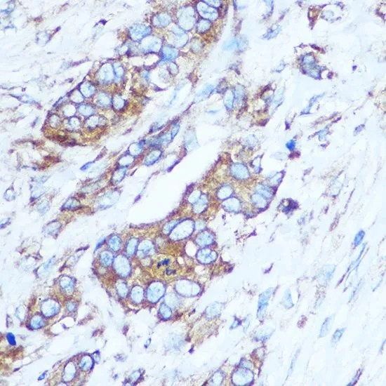 IHC-P analysis of human breast cancer tissue using GTX55652 GSTT1 antibody. Dilution : 1:100