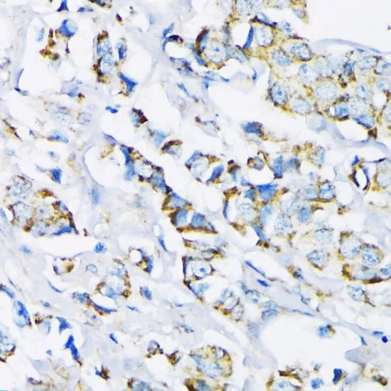 IHC-P analysis of human breast cancer tissue using GTX55657 Hexokinase II antibody. Dilution : 1:200