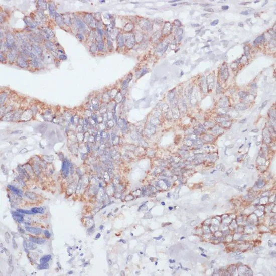 IHC-P analysis of human colon carcinoma tissue using GTX55673 IKK epsilon antibody. Dilution : 1:200