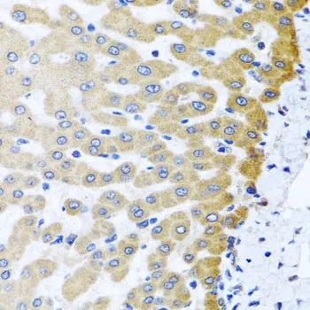 IHC-P analysis of human liver damage tissue using GTX55693 M6PR (cation dependent) antibody. Dilution : 1:100