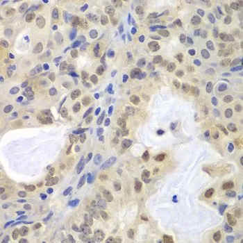 IHC-P analysis of human oophoroma tissue using GTX55699 MCM3 antibody. Dilution : 1:100