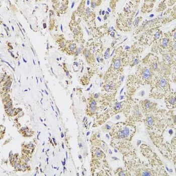 IHC-P analysis of human liver damage tissue using GTX55700 MDH2 antibody. Dilution : 1:100