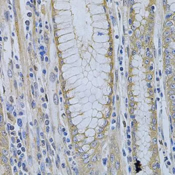 IHC-P analysis of human gastric cancer tissue using GTX55715 MVP/LRP antibody. Dilution : 1:200 IHC-P analysis of human gastric cancer tissue using GTX55715 MVP/LRP antibody. Dilution : 1:200