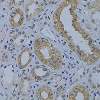IHC-P analysis of human kidney cancer tissue using GTX55715 MVP/LRP antibody. Dilution : 1:200 IHC-P analysis of human kidney cancer tissue using GTX55715 MVP/LRP antibody. Dilution : 1:200