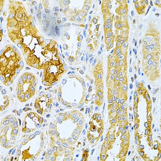 IHC-P analysis of human kidney cancer tissue using GTX55734 OPG antibody. Dilution : 1:200