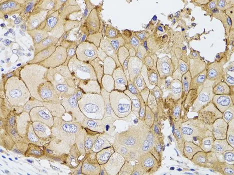 IHC-P analysis of human breast cancer tissue using GTX55741 PDE4D antibody. Dilution : 1:100