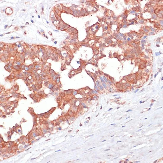 IHC-P analysis of human mammary cancer tissue using GTX55744 PGD antibody. Dilution : 1:100