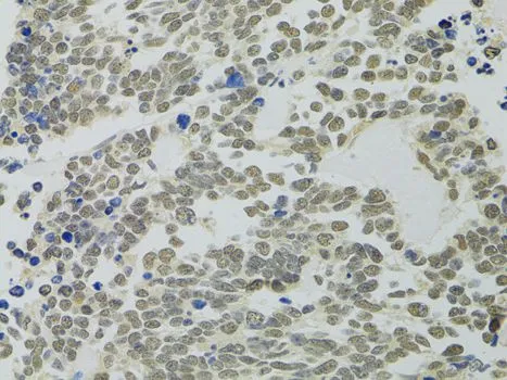 IHC-P analysis of human lung cancer tissue using GTX55756 PPP4C antibody. Dilution : 1:100