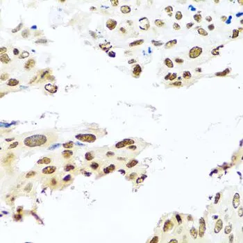 IHC-P analysis of human lung cancer tissue using GTX55771 RAB3IP antibody. Dilution : 1:100