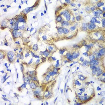 IHC-P analysis of human liver cancer tissue using GTX55785 RPL9 antibody. Dilution : 1:100