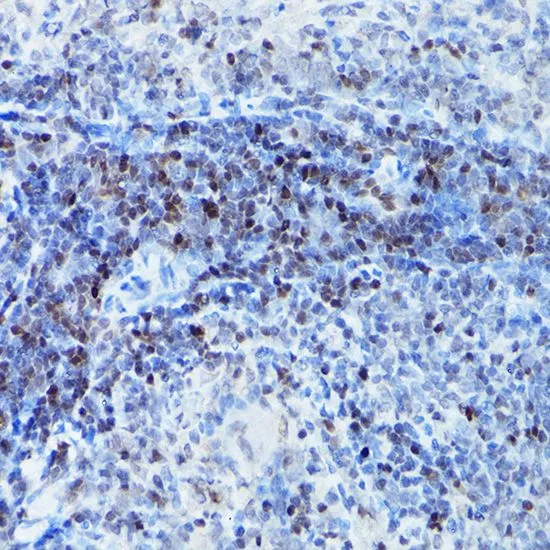 IHC-P analysis of human colon carcinoma tissue using GTX55787 SATB1 antibody. Dilution : 1:100