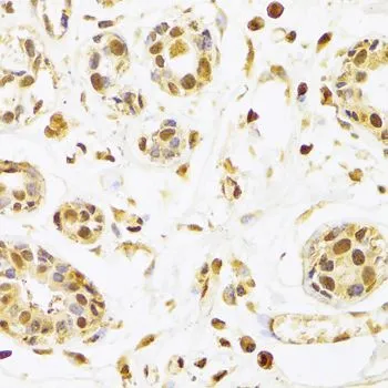 IHC-P analysis of human breast tissue using GTX55789 Selenophosphate synthetase 1 antibody. Dilution : 1:100