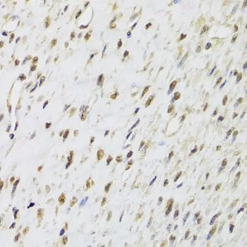 IHC-P analysis of human leiomyoma of uterus tissue using GTX55789 Selenophosphate synthetase 1 antibody. Dilution : 1:100