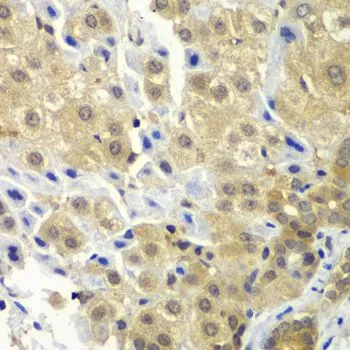 IHC-P analysis of human liver cancer tissue using GTX55797 SGTA antibody. Dilution : 1:100