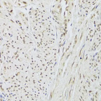 IHC-P analysis of human adenomyosis tissue using GTX55804 SNRPA antibody. Dilution : 1:100