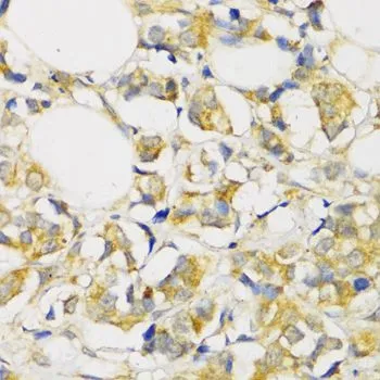 IHC-P analysis of human breast cancer tissue using GTX55814 TGF beta Receptor 2 antibody. Dilution : 1:100