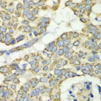 IHC-P analysis of human esophageal cancer tissue using GTX55825 TUFM antibody. Dilution : 1:100