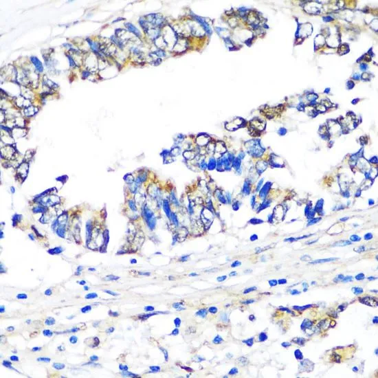 IHC-P analysis of human colon carcinoma tissue using GTX55840 Visfatin antibody. Dilution : 1:100