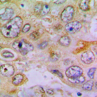 IHC-P analysis of formalin fixed human lung cancer tissue section using GTX55931 RPL35 antibody. Antigen retrieval : Heat mediated antigen retrieval with sodium citrate buffer (pH 6.0) IHC-P analysis of formalin fixed human lung cancer tissue section using GTX55931 RPL35 antibody. Antigen retrieval : Heat mediated antigen retrieval with sodium citrate buffer (pH 6.0)