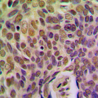 IHC-P analysis of formalin fixed human breast cancer tissue section using GTX55940 BRMS1 antibody. Antigen retrieval : Heat mediated antigen retrieval with sodium citrate buffer (pH 6.0)
