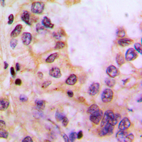 IHC-P analysis of formalin fixed human liver cancer tissue section using GTX55952 CYP39A1 antibody. Antigen retrieval : Heat mediated antigen retrieval with sodium citrate buffer (pH 6.0) IHC-P analysis of formalin fixed human liver cancer tissue section using GTX55952 CYP39A1 antibody. Antigen retrieval : Heat mediated antigen retrieval with sodium citrate buffer (pH 6.0)