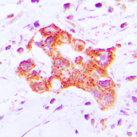 IHC-P analysis of formalin fixed human lung cancer tissue section using GTX55953 CYP39A1 antibody. Antigen retrieval : Heat mediated antigen retrieval with sodium citrate buffer (pH 6.0) IHC-P analysis of formalin fixed human lung cancer tissue section using GTX55953 CYP39A1 antibody. Antigen retrieval : Heat mediated antigen retrieval with sodium citrate buffer (pH 6.0)