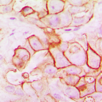 IHC-P analysis of formalin fixed human breast cancer tissue section using GTX55966 PMEPA1 antibody. Antigen retrieval : Heat mediated antigen retrieval with sodium citrate buffer (pH 6.0) IHC-P analysis of formalin fixed human breast cancer tissue section using GTX55966 PMEPA1 antibody. Antigen retrieval : Heat mediated antigen retrieval with sodium citrate buffer (pH 6.0)