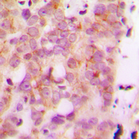 IHC-P analysis of formalin fixed human breast cancer tissue section using GTX56102 HLA-H antibody. Antigen retrieval : Heat mediated antigen retrieval with sodium citrate buffer (pH 6.0)
