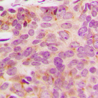IHC-P analysis of formalin fixed human breast cancer tissue section using GTX56108 NDUFA3 antibody. Antigen retrieval : Heat mediated antigen retrieval with sodium citrate buffer (pH 6.0) IHC-P analysis of formalin fixed human breast cancer tissue section using GTX56108 NDUFA3 antibody. Antigen retrieval : Heat mediated antigen retrieval with sodium citrate buffer (pH 6.0)
