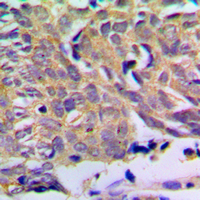IHC-P analysis of formalin fixed human prostate cancer tissue section using GTX56115 PXMP2 antibody. Antigen retrieval : Heat mediated antigen retrieval with sodium citrate buffer (pH 6.0) IHC-P analysis of formalin fixed human prostate cancer tissue section using GTX56115 PXMP2 antibody. Antigen retrieval : Heat mediated antigen retrieval with sodium citrate buffer (pH 6.0)