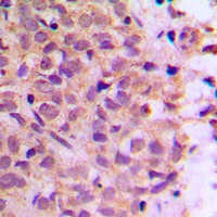 IHC-P analysis of formalin fixed human breast cancer tissue section using GTX56142 COPZ1 antibody. Antigen retrieval : Heat mediated antigen retrieval with sodium citrate buffer (pH 6.0)