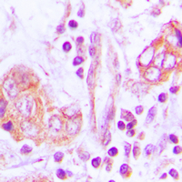 IHC-P analysis of formalin fixed human lung cancer tissue section using GTX56189 OTUB2 antibody. Antigen retrieval : Heat mediated antigen retrieval with sodium citrate buffer (pH 6.0) IHC-P analysis of formalin fixed human lung cancer tissue section using GTX56189 OTUB2 antibody. Antigen retrieval : Heat mediated antigen retrieval with sodium citrate buffer (pH 6.0)