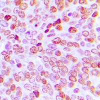 IHC-P analysis of formalin fixed human prostate cancer tissue section using GTX56239 TBP antibody. Antigen retrieval : Heat mediated antigen retrieval with sodium citrate buffer (pH 6.0)