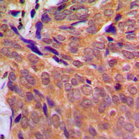 IHC-P analysis of formalin fixed human breast cancer tissue section using GTX56248 Chk1 antibody. Antigen retrieval : Heat mediated antigen retrieval with sodium citrate buffer (pH 6.0)