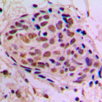 IHC-P analysis of formalin fixed human breast cancer tissue section using GTX56252 CREB antibody. Antigen retrieval : Heat mediated antigen retrieval with sodium citrate buffer (pH 6.0)
