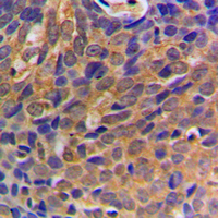 IHC-P analysis of formalin fixed human breast cancer tissue section using GTX56267 beta Catenin antibody. Antigen retrieval : Heat mediated antigen retrieval with sodium citrate buffer (pH 6.0) IHC-P analysis of formalin fixed human breast cancer tissue section using GTX56267 beta Catenin antibody. Antigen retrieval : Heat mediated antigen retrieval with sodium citrate buffer (pH 6.0)