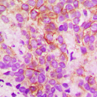 IHC-P analysis of formalin fixed human breast cancer tissue section using GTX56284 CYP2B6 antibody. Antigen retrieval : Heat mediated antigen retrieval with sodium citrate buffer (pH 6.0)