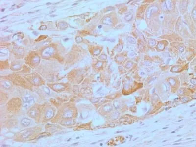 IHC-P analysis of human esophageal squamous cell carcinoma (SCC) tissue using GTX57153 TLR4 antibody [76B357.1]. Dilution : 5 microg/ml