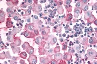 IHC-P analysis of human skin, melanoma tissue using GTX57163 OR10J5 antibody. Antigen retrieval : Heat-induced antigen retrieval