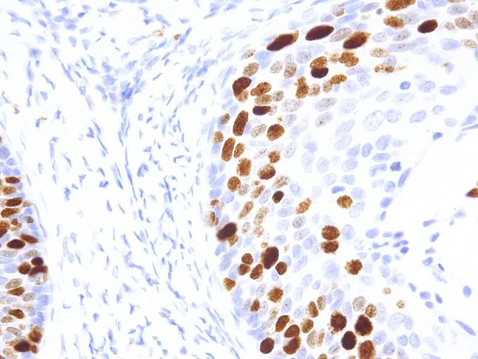IHC-P analysis of human cervical cancer tissue using GTX57186 Ki67 antibody [IHC067] (40X)