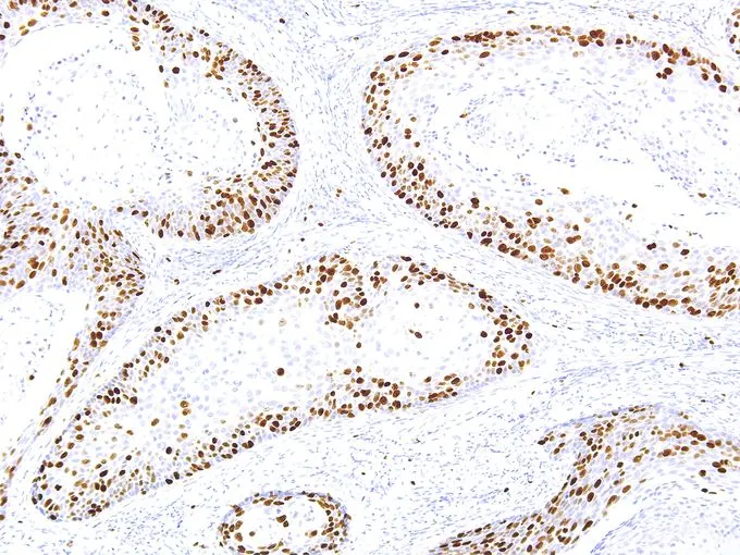 IHC-P analysis of human cervical cancer tissue using GTX57186 Ki67 antibody [IHC067] (10X)