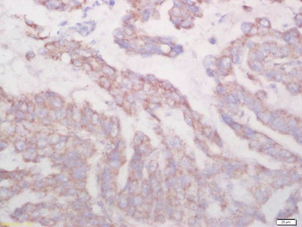 IHC-P analysis of human lung carcinoma tissue using GTX57229 Uteroglobin antibody. Dilution : 1:200